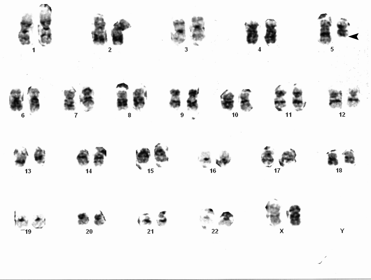 Karyotype on bone marrow aspirate showing deletion of long arm of chromosome 5 (5q-)(arrowhead)
